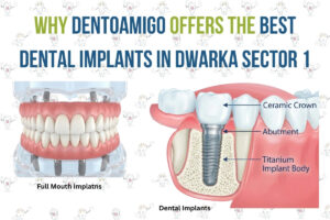 Best Dental implants diagram showing ceramic crown, abutment, titanium implant body, and full-mouth implants by Dentoamigo in Dwarka Sector 1