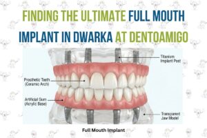 Full mouth implant in Dwarka diagram showing titanium posts, prosthetic teeth, and acrylic base by Dentoamigo