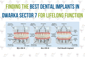 Diagram comparing All-on-4, All-on-6, and Best Dental Implants in Dwarka sector 7 with jaw structure and abutments