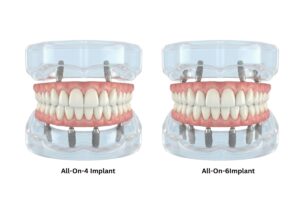 Comparison image of All-on-4 and All-on-6 full-mouth dental implants at Dentoamigo