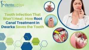 Root Canal Treatment in Dwarka showing infected tooth, cleaning of canals, and relief from severe tooth pain.