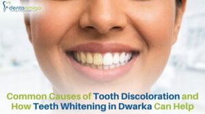 Before and after teeth whitening results showing improved tooth color at a dental clinic in Dwarka